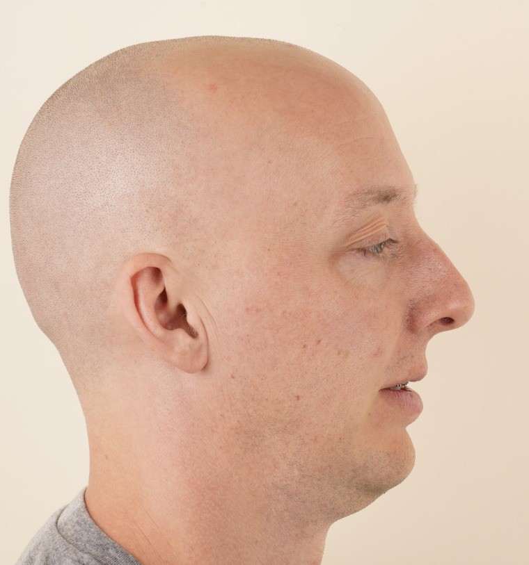 Baseline right profile photograph before any planned movement
