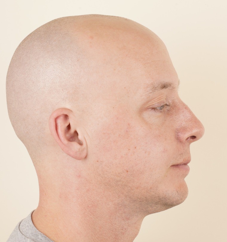 Photograph of the same right profile five weeks after bimaxillary surgery, in the same frame as the pre-operative photograph
