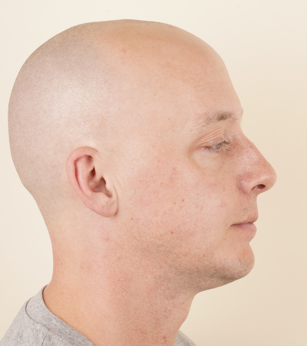 Photograph of the same profile five weeks after surgery, in the same frame as the pre-operative photograph