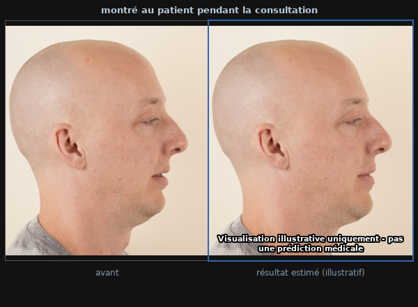 Le résultat montré au patient : photographie initiale à côté de l'après estimé illustratif