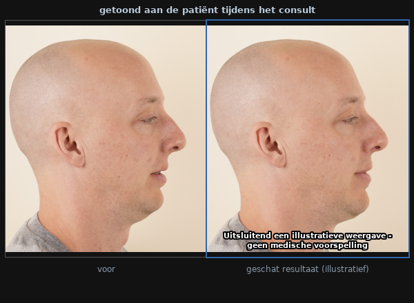 Het resultaat dat de patiënt te zien krijgt: uitgangsfoto naast de illustratieve geschatte na-situatie