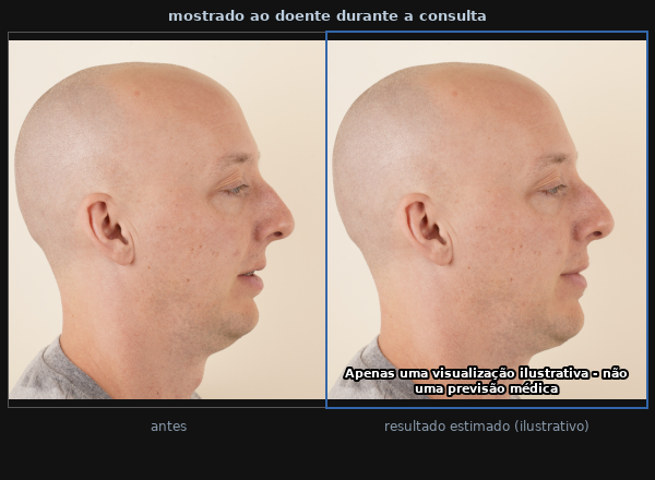 O resultado mostrado ao doente: fotografia inicial ao lado do depois estimado ilustrativo